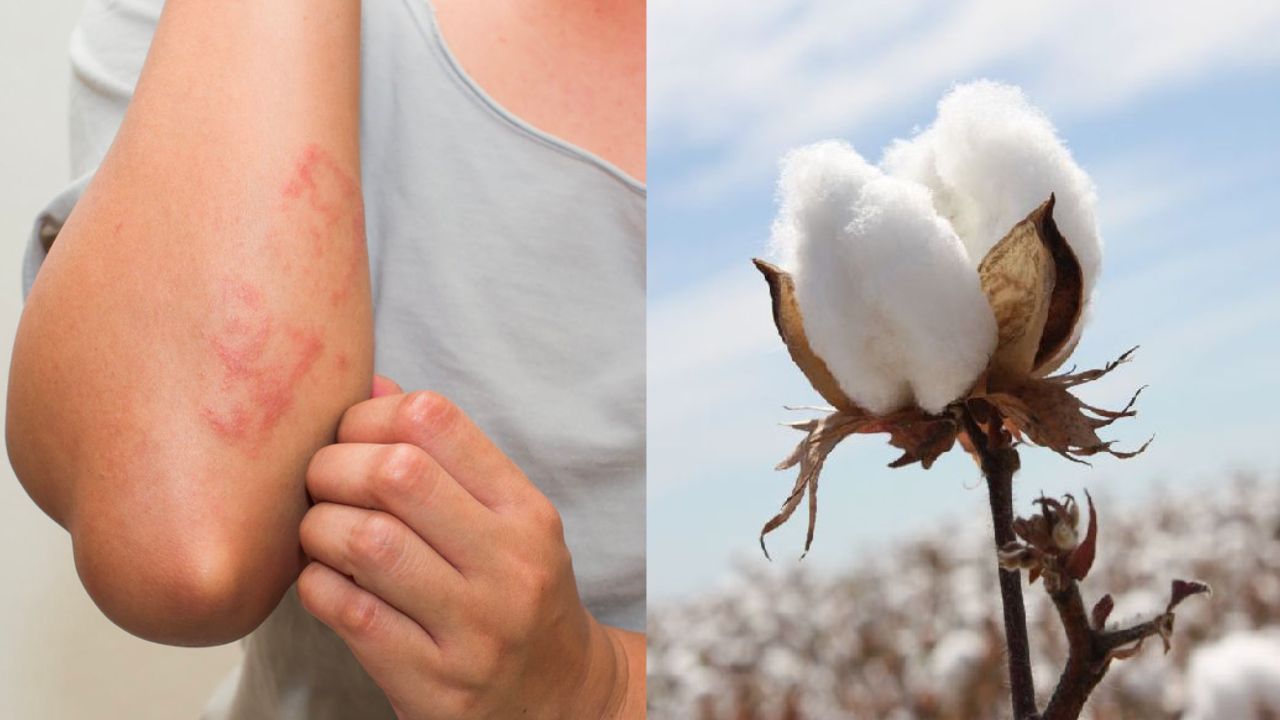 Skin diseases caused by cotton